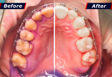 How To Remove Tartar From Teeth Without A Dentist